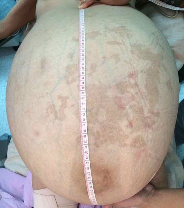 【閲覧注意】体重の半分ほどの腫瘍を宿した女性がこちら。(画像)・2枚目