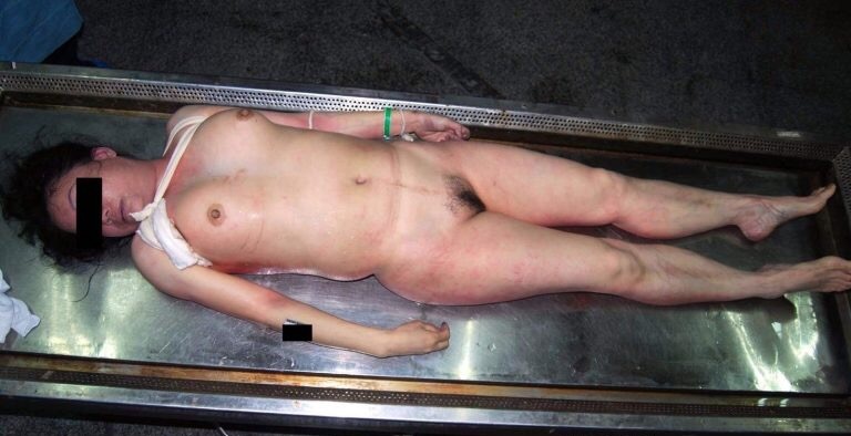 【超・閲覧注意】検死解剖で全裸の女性から出てきたモノ。。(画像)・1枚目