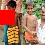 【奇形児】インドでかつて神と崇められた少年、手術前の画像がヤバすぎる！！(画像)