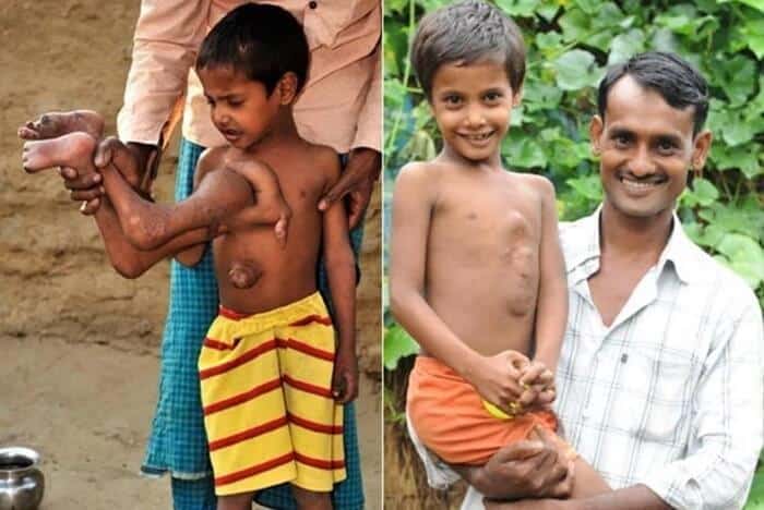 【奇形児】インドでかつて神と崇められた少年、手術前の画像がヤバすぎる！！(画像)・1枚目