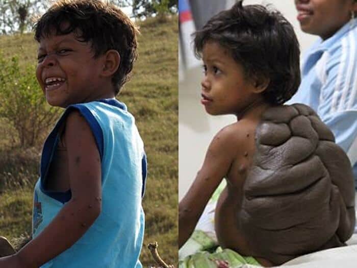 【奇形児】インドでかつて神と崇められた少年、手術前の画像がヤバすぎる！！(画像)・3枚目