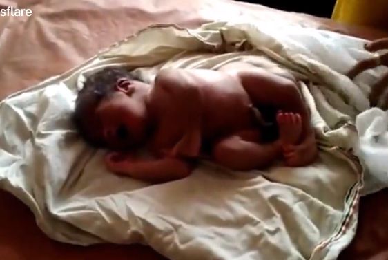 【神の奇跡】インドで生まれた4本足の赤ちゃん、生命の神秘凄過ぎだろ・・・・(動画)・1枚目