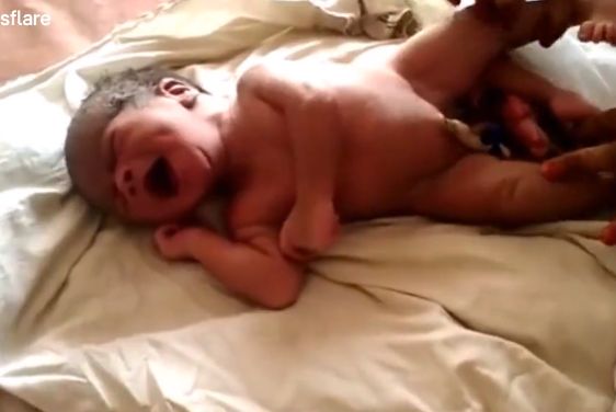 【神の奇跡】インドで生まれた4本足の赤ちゃん、生命の神秘凄過ぎだろ・・・・(動画)・2枚目