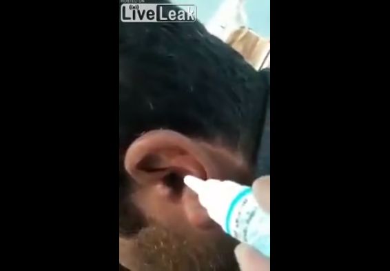 【衝撃】耳に異物がと病院を訪れた男性、耳から出てきたのは・・・・・(動画)・1枚目