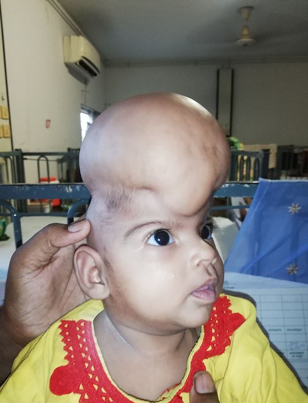 【衝撃】パキスタンで生まれた頭蓋骨の外側に脳を持つ少女、これかなり危ないだろ・・・・・(画像)・3枚目