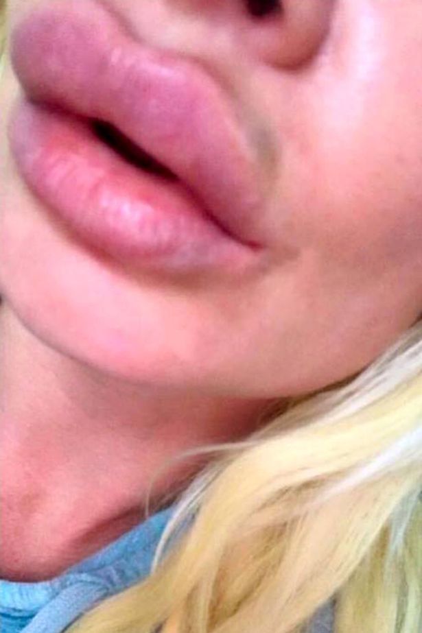 【衝撃】唇の整形手術代をケチったイギリス人女性、とんでもない唇にされる・・・・・(画像)・4枚目