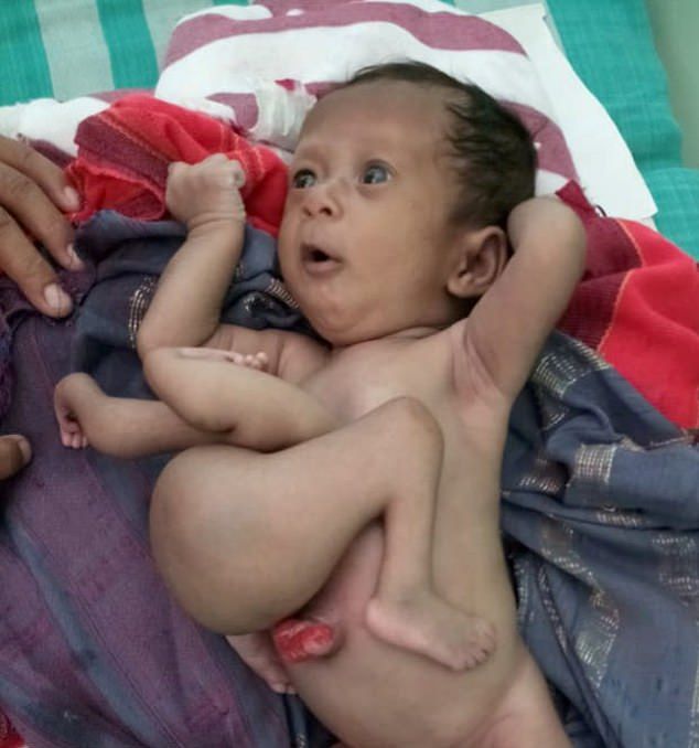 【神の使い】インドで生まれた結合双生児の少女、無事分離手術が成功する！！(画像)・1枚目
