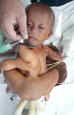 【神の使い】インドで生まれた結合双生児の少女、無事分離手術が成功する！！(画像)・3枚目