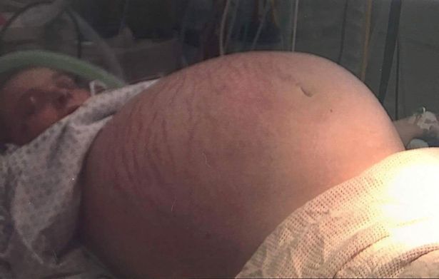 【衝撃】お腹に26㎏の超巨大な嚢胞が出来たイギリス人女性、これ妊婦だろ・・・・・(画像)・2枚目