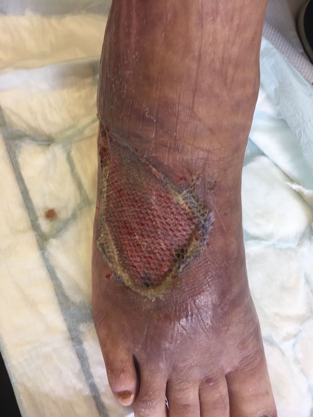 【衝撃】アフリカで虫に刺されて足の一部が壊死した男性、無菌ワームで見事に治療！！(画像)・4枚目