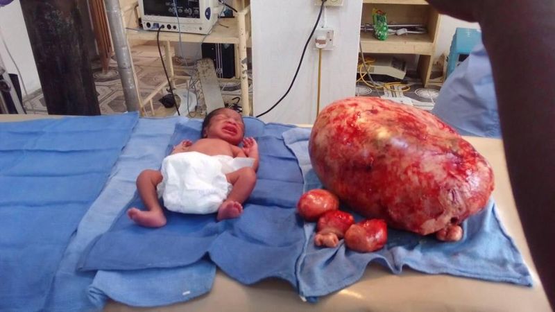 【衝撃】帝王切開で赤ん坊と同時に母体から切除された子宮筋腫、赤ちゃんよりデカい・・・・・(画像)・1枚目