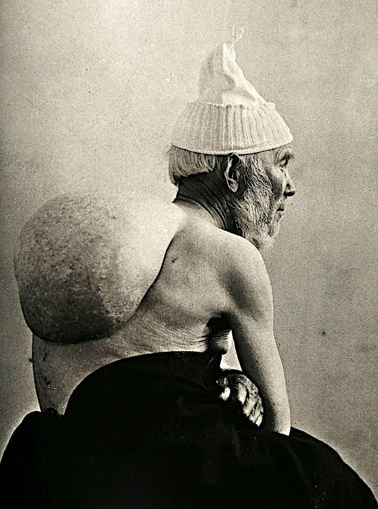 【衝撃】19世紀のオランダで撮影された奇形を持つ人達の資料画像、何とも言えないな・・・・・(画像)・1枚目