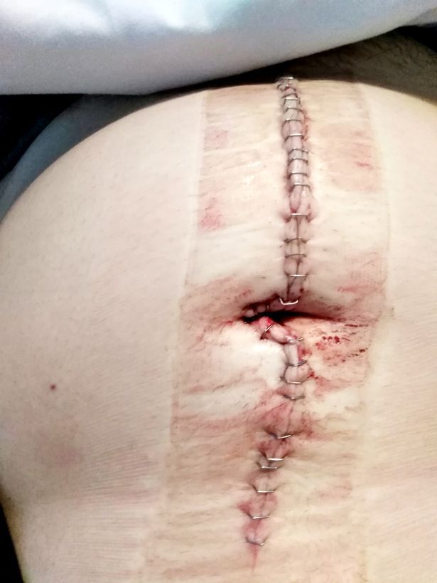 【中身は？】妊娠したと勘違いした女性の腹部から摘出された40㎝の腫瘍、デカすぎだろ！！(画像)・6枚目