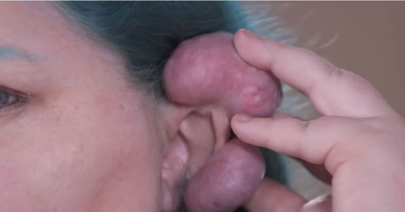 【ヤバ過ぎ】ピアスの穴がキッカケで感染症にかかった女性、耳がとんでもない状態になる！！(画像)・3枚目