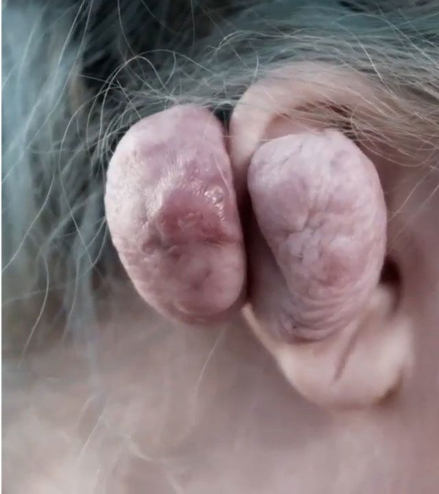 【ヤバ過ぎ】ピアスの穴がキッカケで感染症にかかった女性、耳がとんでもない状態になる！！(画像)・4枚目