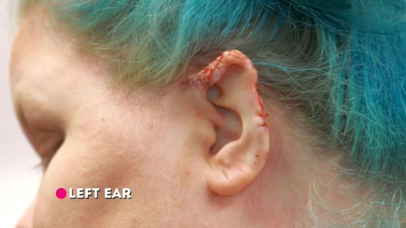 【ヤバ過ぎ】ピアスの穴がキッカケで感染症にかかった女性、耳がとんでもない状態になる！！(画像)・8枚目