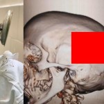 【怖過ぎ】躓いて転倒し頭蓋骨をストーブの蓋が貫通したインド女性、無事手術を受け生還する！！