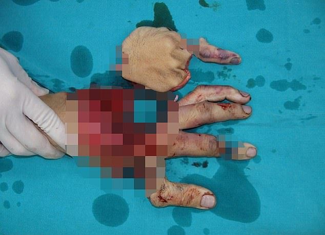 【リアルBJ】タイの凄腕外科医、木端微塵になった作業員の手を見事復元させる！！・1枚目