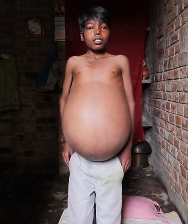 【奇病】インド自転車工場で働く少年、病気で妊婦以上のボテ腹に成長してしまう・・・・・(画像)・1枚目