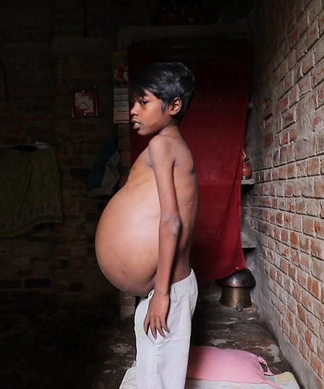 【奇病】インド自転車工場で働く少年、病気で妊婦以上のボテ腹に成長してしまう・・・・・(画像)・3枚目