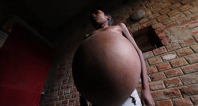 【奇病】インド自転車工場で働く少年、病気で妊婦以上のボテ腹に成長してしまう・・・・・(画像)・4枚目