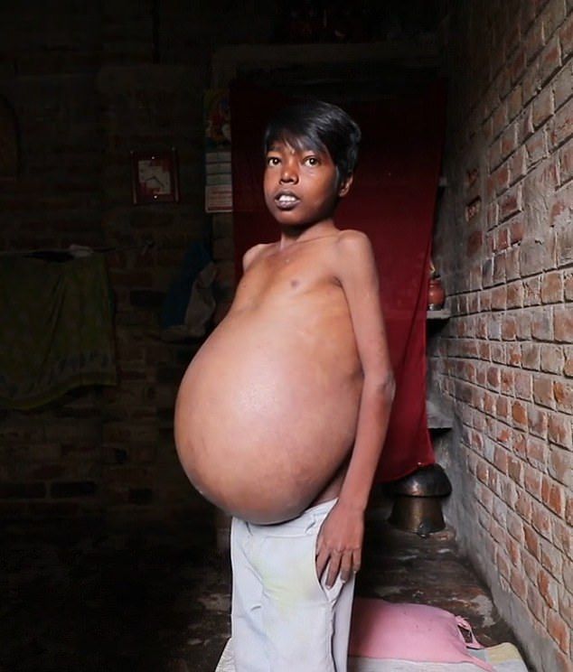 【奇病】インド自転車工場で働く少年、病気で妊婦以上のボテ腹に成長してしまう・・・・・(画像)・5枚目