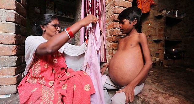 【奇病】インド自転車工場で働く少年、病気で妊婦以上のボテ腹に成長してしまう・・・・・(画像)・7枚目
