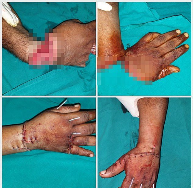 【リアルBJ】路上喧嘩で左手をほぼ切り落とされたインド人男性、凄腕外科医に完璧に修復される！！(画像)・3枚目