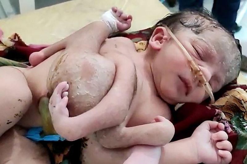 【神の化身】インドで生まれた結合双生児、4本の腕と3本の足を持って生まれてくる！！(画像)・3枚目